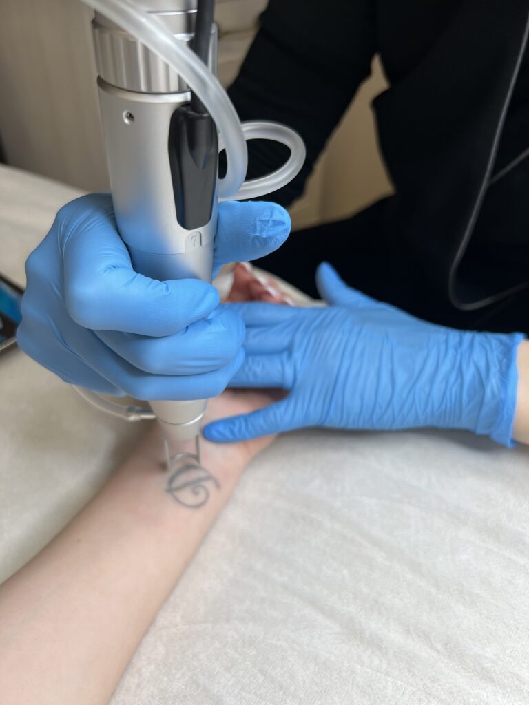 tatuiruočių šalinimas Nedidelių tatuiruočių šalinimas lazeriu vilniuje